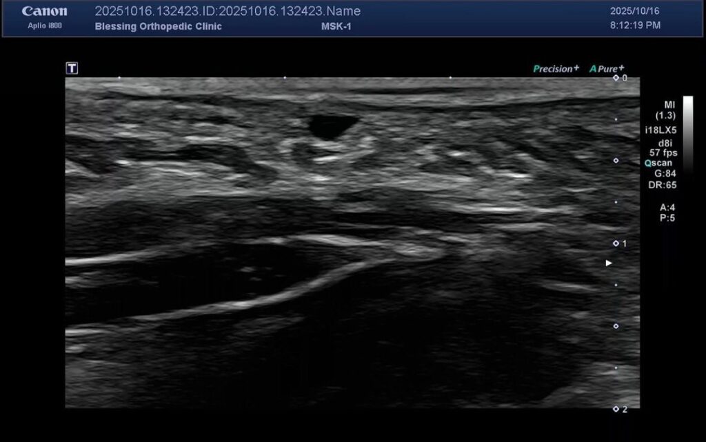 長期勞動者手掌出現腱鞘囊腫需經由評估手術