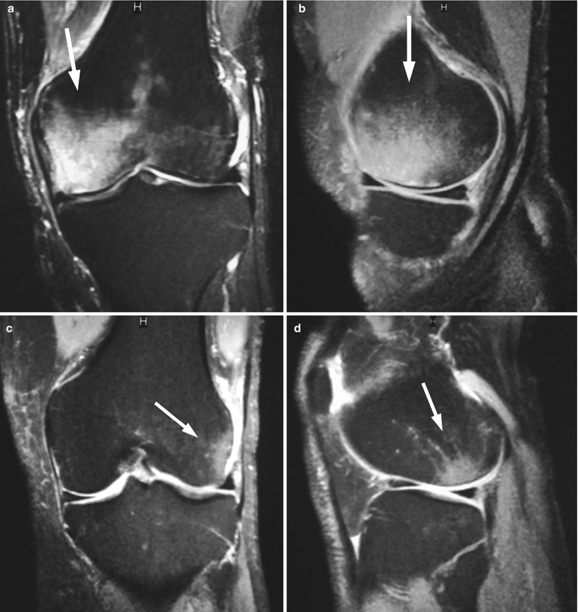 骨挫傷(Bone Bruise)或骨髓水腫(Bone Marrow Edema, BME),這種微觀層級的細微骨折,會導致骨髓內部出血、發炎、水腫,產生深層的疼痛 。