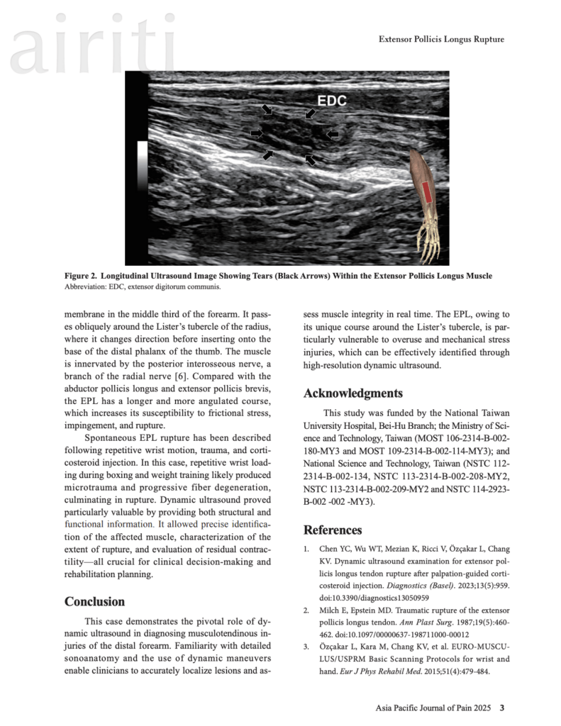 Dynamic Ultrasound for Rare EPL Muscle Rupture - 陳昱傑骨科診所