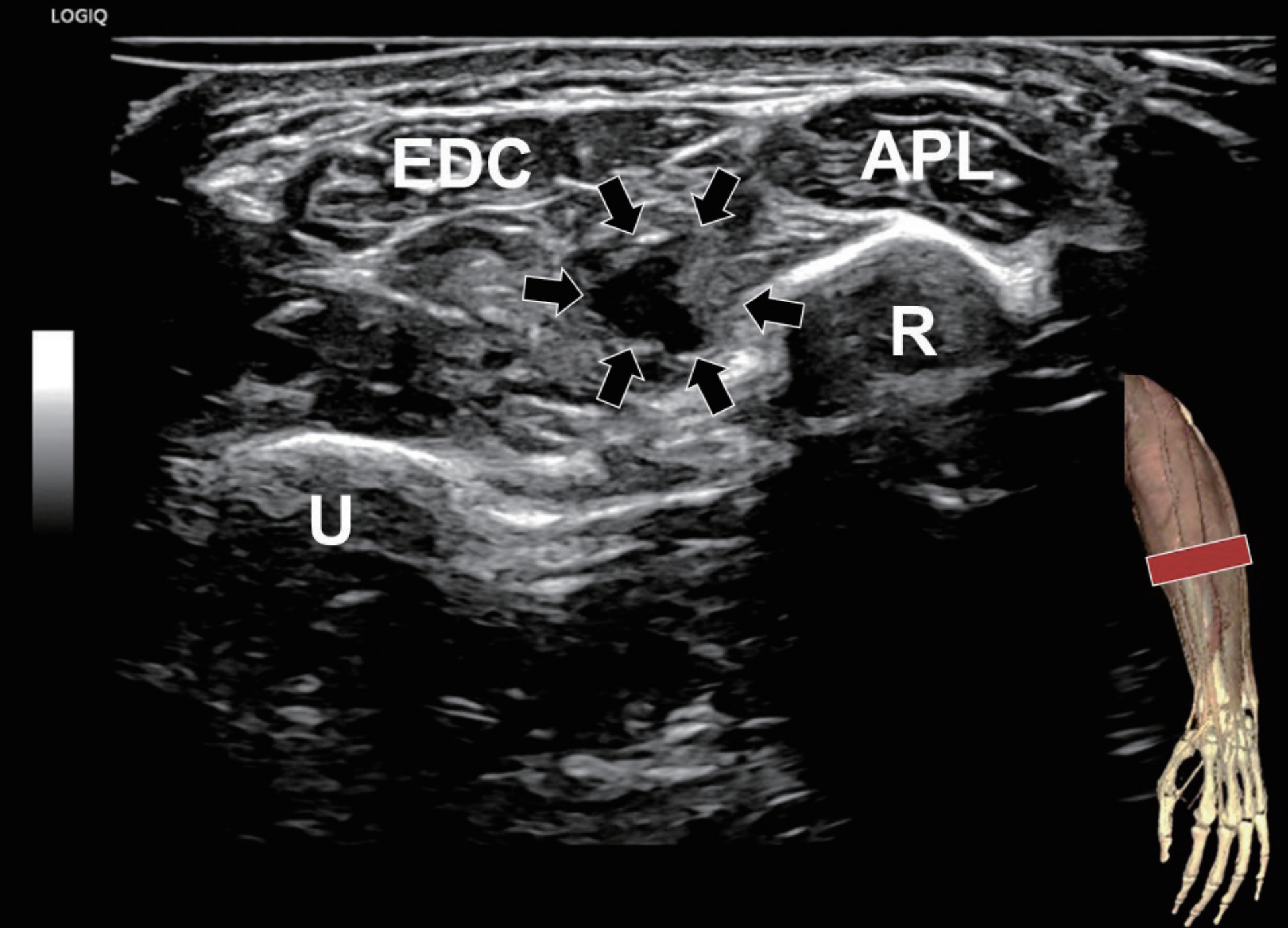 Dynamic Ultrasound for Rare EPL Muscle Rupture - 陳昱傑骨科診所