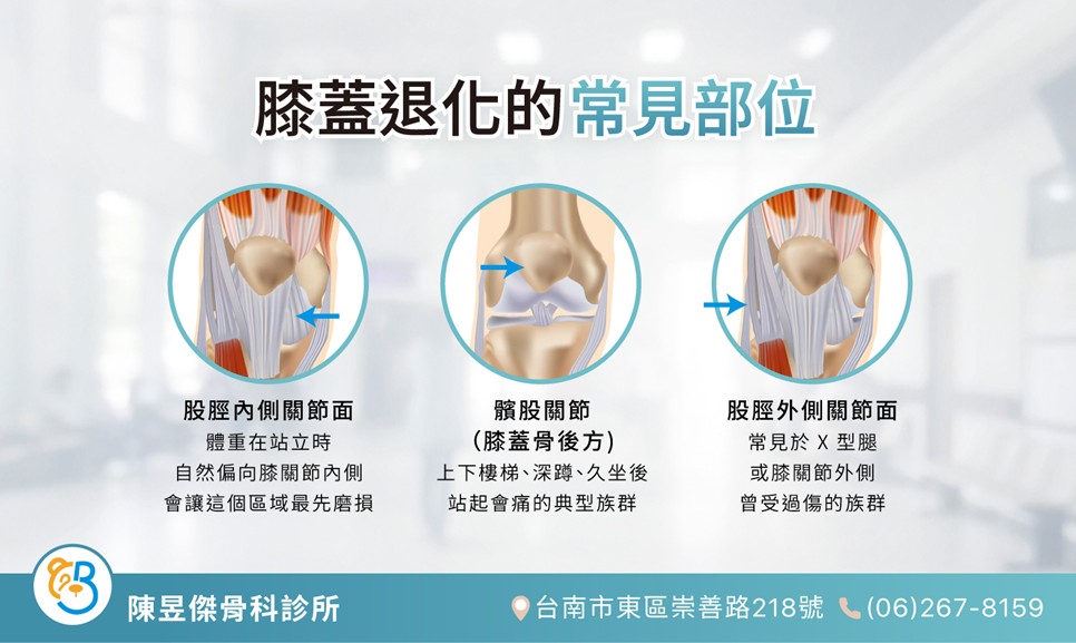 膝蓋退化打 PRP 有效嗎?適合誰打、要打幾次、效果能維持多久 1 a